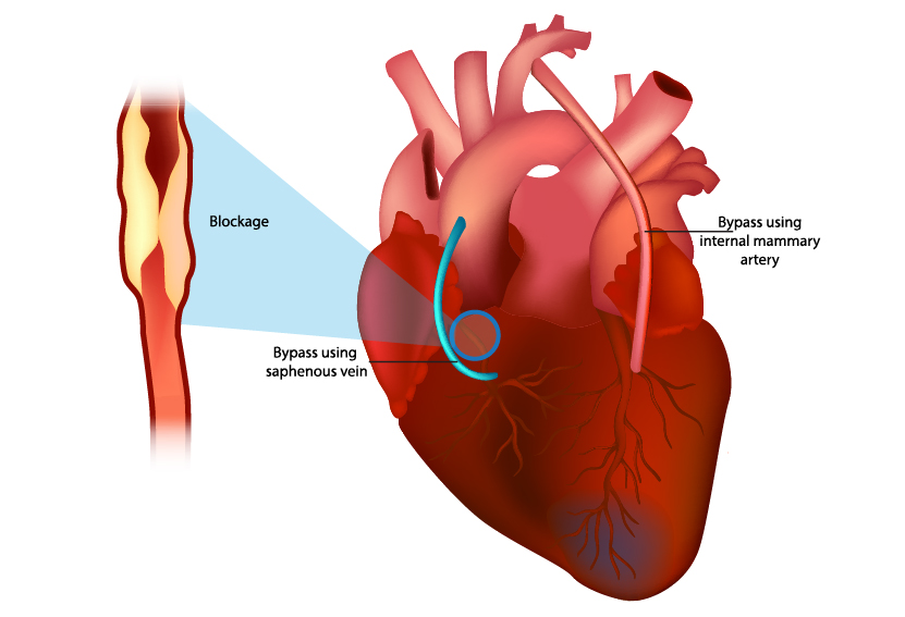 What are the signs and symptoms of Heart Block
